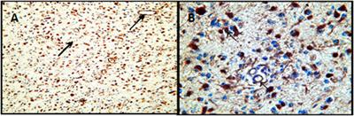 Heterogeneous Expression of Proangiogenic and Coagulation Proteins in Gliomas of Different Histopathological Grade